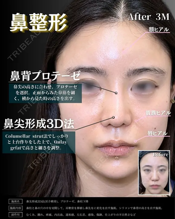 【鼻整形】鼻尖形成3D法＋耳介軟骨移植＋鼻柱下降＋プロテーゼ before画像 メイン用