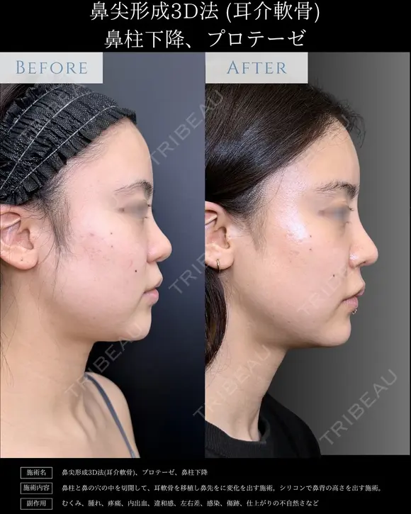 【鼻整形】鼻尖形成3D法＋耳介軟骨移植＋鼻柱下降＋プロテーゼ after画像 メイン用
