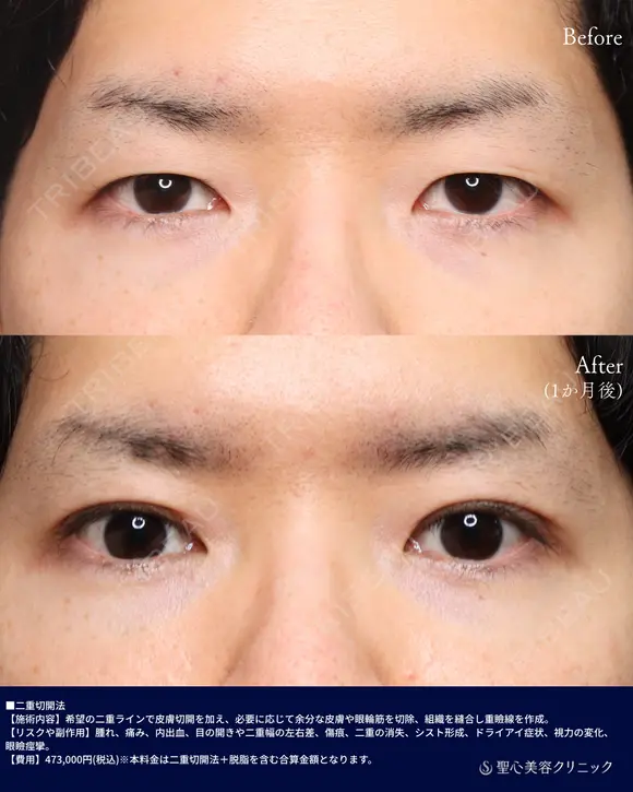 二重切開法+脱脂 before画像 メイン用