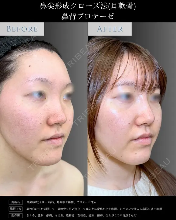 【鼻整形】鼻尖形成クローズ法＋耳介軟骨移植 before画像 メイン用
