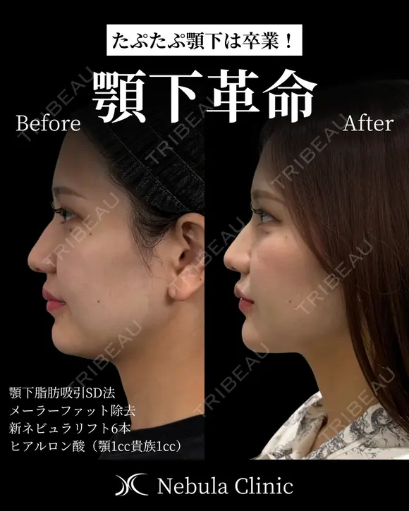 ⭐DR都築⭐小顔カスタマイズ before画像 メイン用