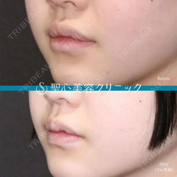 【10代女性】M字リップ（キュートリップ、切開法） 30日後 メイン用