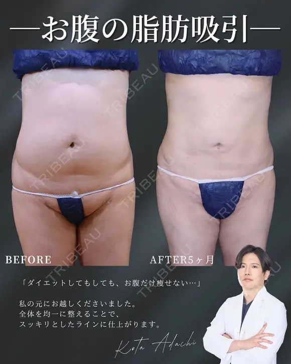 ぽっこりお腹卒業🎓⭐ before画像 メイン用