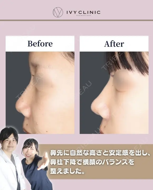 鼻尖形成　軟骨移植 after画像 メイン用