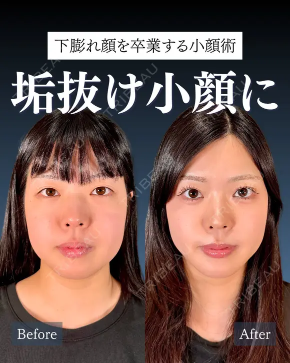 岩﨑先生による✨小顔整形✨ after画像 メイン用