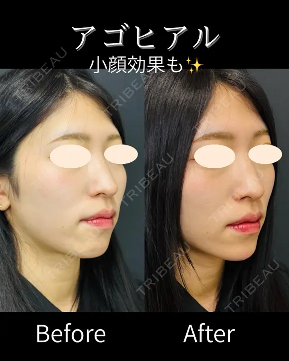 アゴヒアル before画像 メイン用