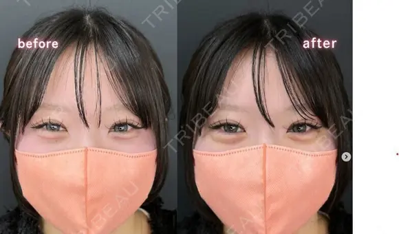 涙袋ヒアルロン酸 before画像 メイン用