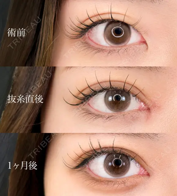 目頭切開 before画像 メイン用