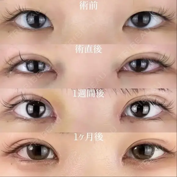 目頭切開 30日後 メイン用