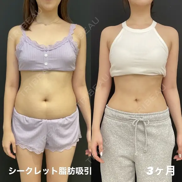 シークレット脂肪吸引 90日後 メイン用