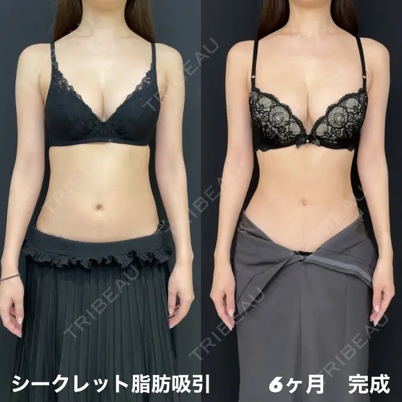 シークレット脂肪吸引 before画像 メイン用