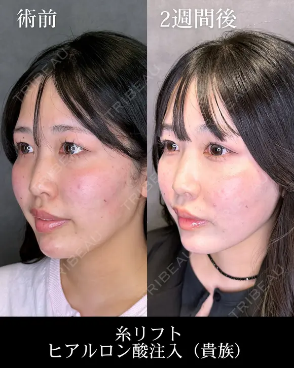 糸リフト/ヒアルロン酸注入（貴族） before画像 メイン用