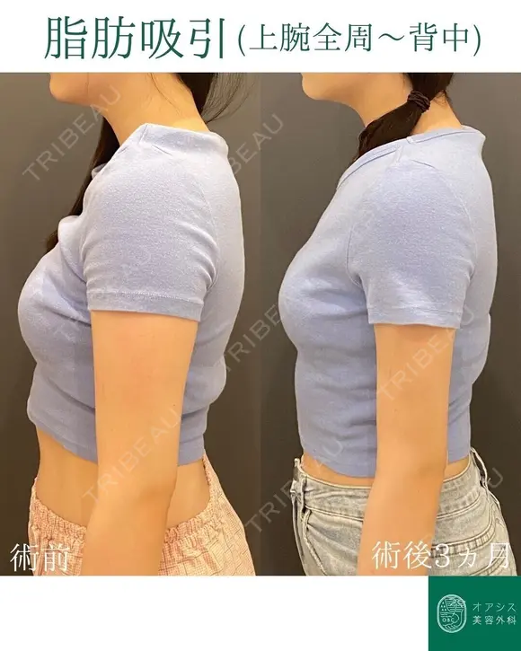 腕の脂肪もたつきを改善🌴コンプリート脂肪吸引【上腕全周～お背中一部】形成外科専門医がご対応 after画像 メイン用