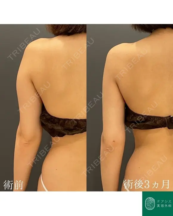 腕の張り出しもすっきり🌴コンプリート脂肪吸引【上腕全周～お背中一部】形成外科専門医がご対応 before画像 メイン用