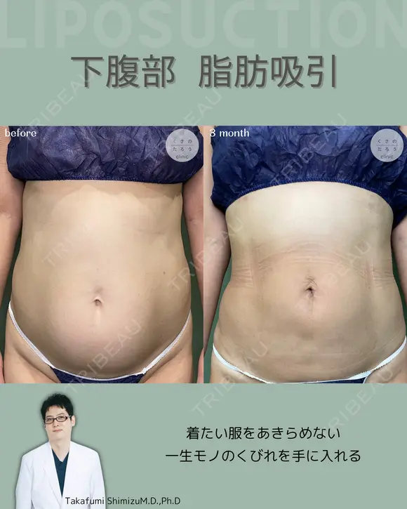 腹部脂肪吸引　『落ちない脂肪は、プロに任せるという選択を✨』 before画像 メイン用