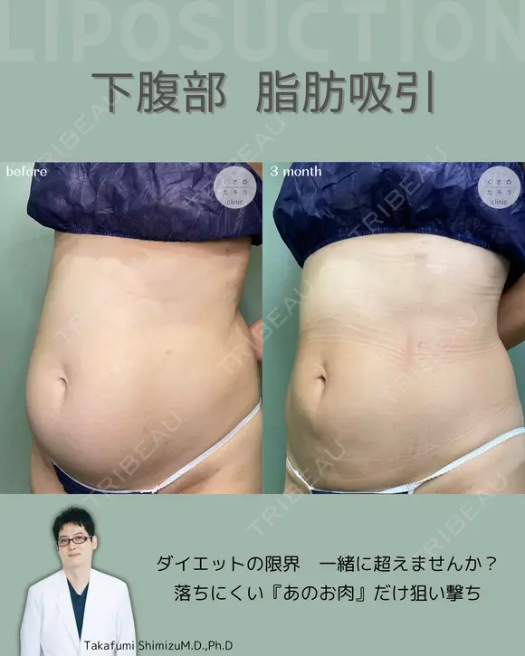 腹部脂肪吸引　『落ちない脂肪は、プロに任せるという選択を✨』 90日後 メイン用