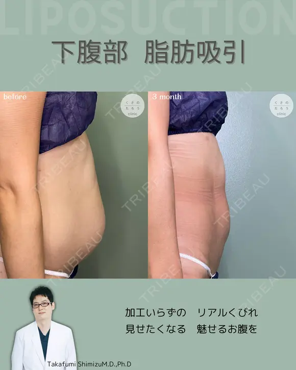 腹部脂肪吸引　『落ちない脂肪は、プロに任せるという選択を✨』 after画像 メイン用