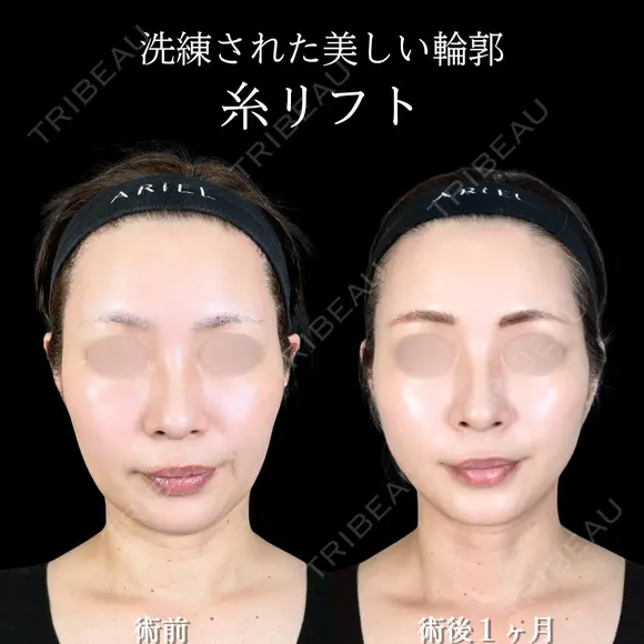 糸リフト 30日後 メイン用