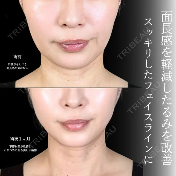 糸リフト before画像 メイン用