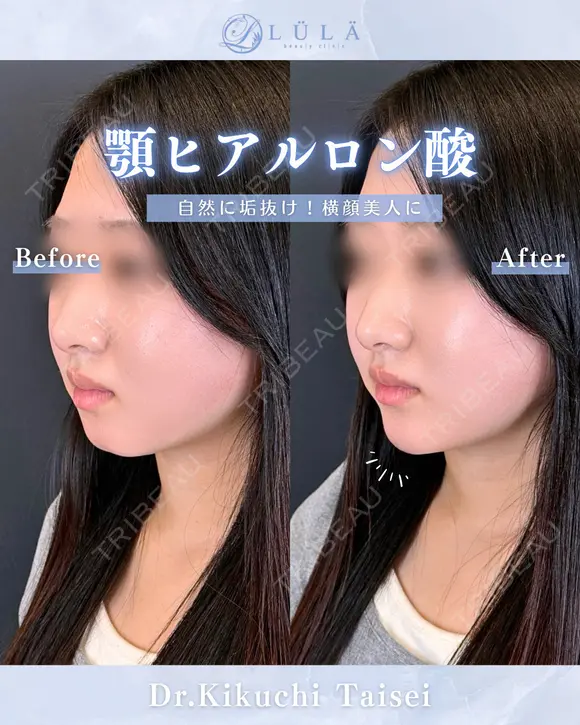 顎ヒアルロン酸 before画像 メイン用