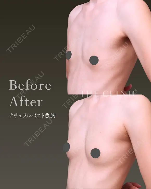 授乳後にしぼんだ胸…脂肪で叶うふっくらバスト✨ before画像 メイン用