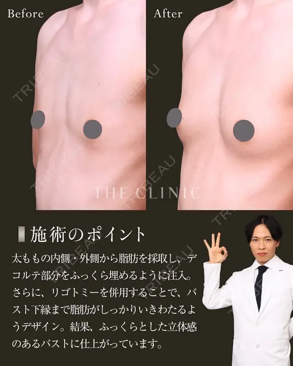 授乳後にしぼんだ胸…脂肪で叶うふっくらバスト✨ after画像 メイン用