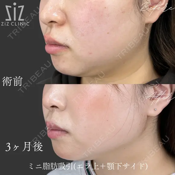 【ミニ脂肪吸引】エラを出したい… before画像 メイン用
