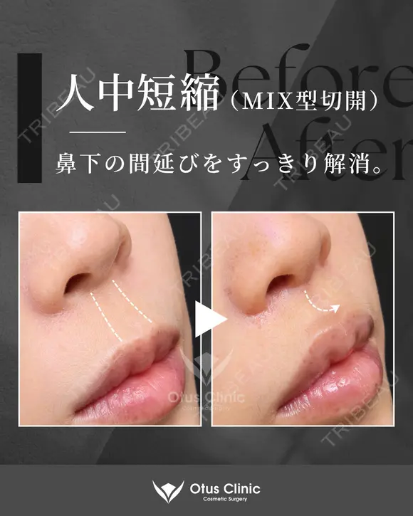 人中短縮（MIX型切開） 90日後 メイン用