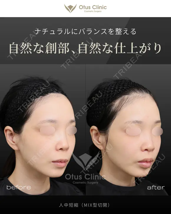 人中短縮（MIX型切開） before画像 メイン用