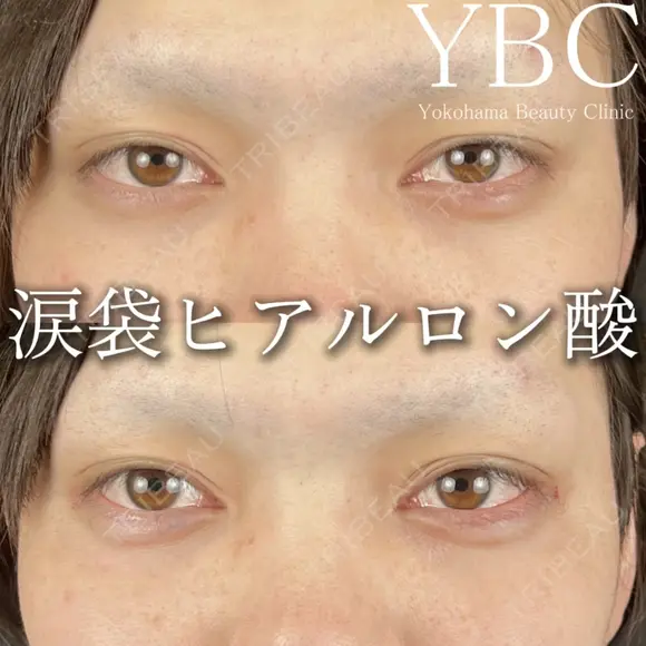 【👀涙袋ヒアルロン酸👀】 after画像 メイン用