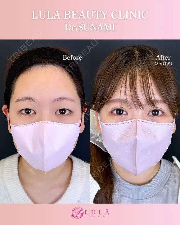 二重埋没 after画像 メイン用