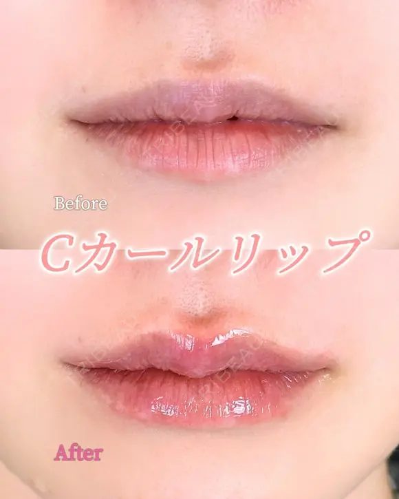 Cカールリップ before画像 メイン用