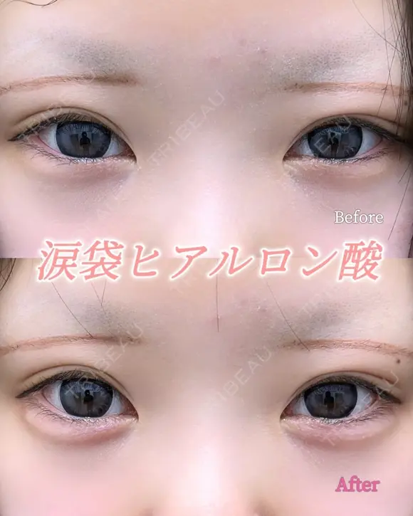 涙袋ヒアルロン酸 after画像 メイン用
