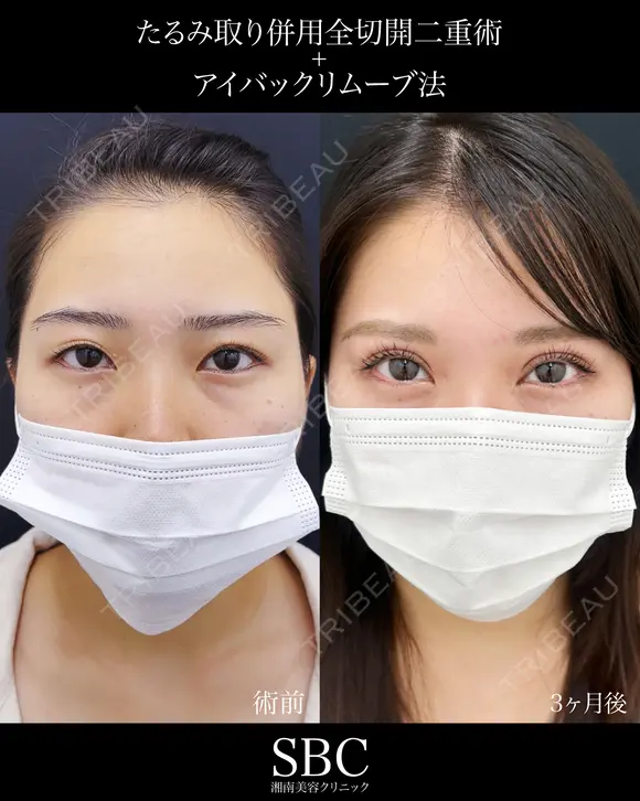 たるみ取り併用全切開二重術・アイバックリムーブ after画像 メイン用