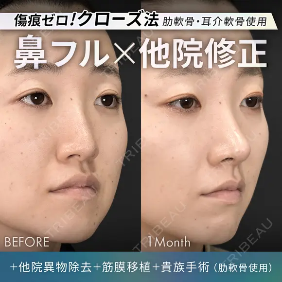 他院異物除去＋鼻フルコース［クローズ法］（肋軟骨・耳介軟骨使用）＋筋膜移植＋貴族手術（肋軟骨使用） 30日後 メイン用