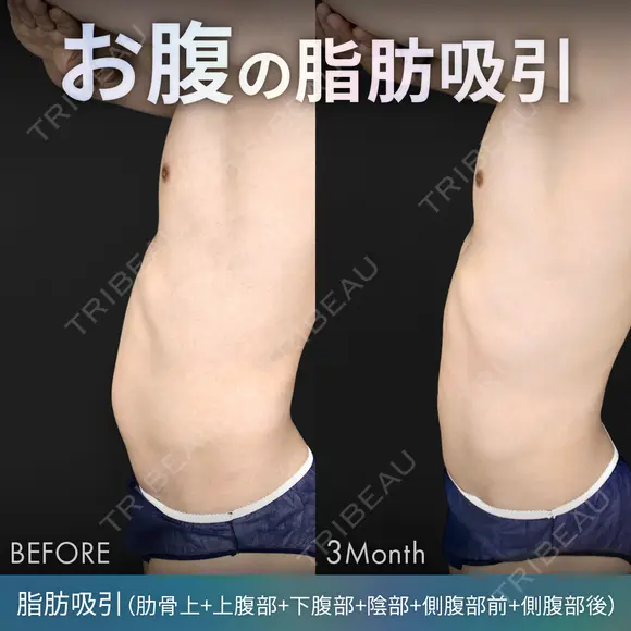 脂肪吸引（腹部全体） before画像 メイン用