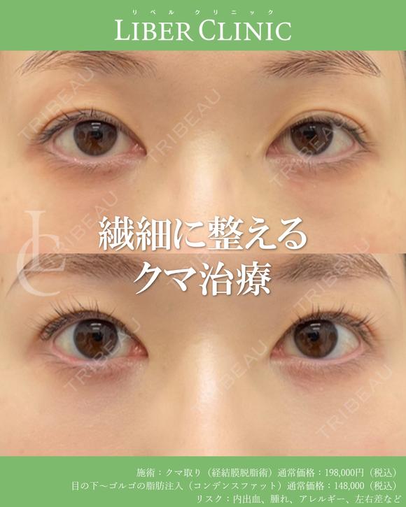 繊細に整えるクマ治療 before画像 メイン用