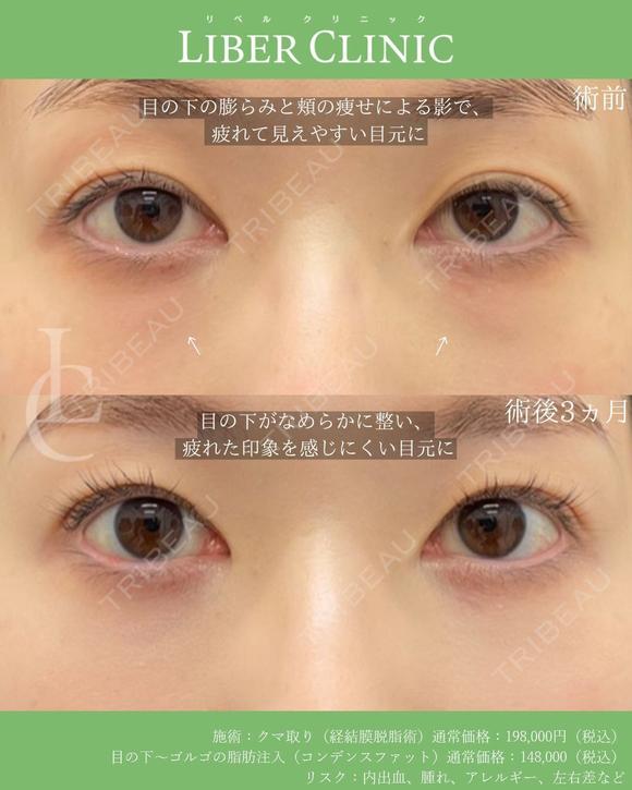 繊細に整えるクマ治療 after画像 メイン用