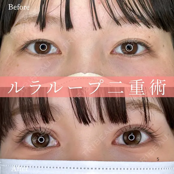 1Dayルラループ二重術 before画像 メイン用