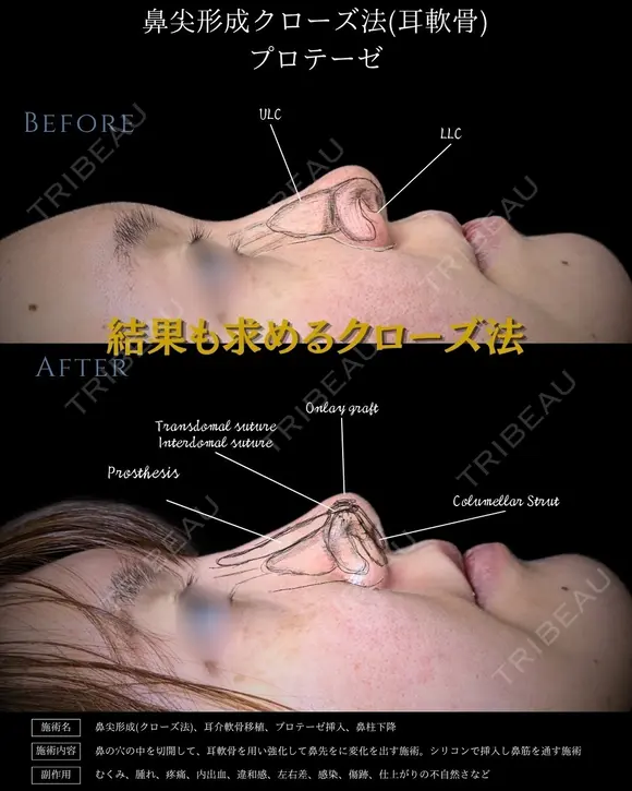 【鼻整形】鼻尖形成クローズ法＋耳介軟骨移植＋鼻背プロテーゼ before画像 メイン用