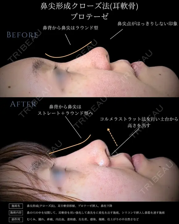 【鼻整形】鼻尖形成クローズ法＋耳介軟骨移植＋鼻背プロテーゼ after画像 メイン用