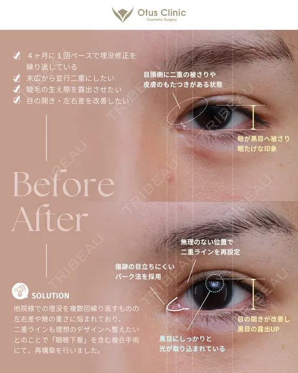 眼瞼下垂 / 目上切開 / 目頭切開 before画像 メイン用