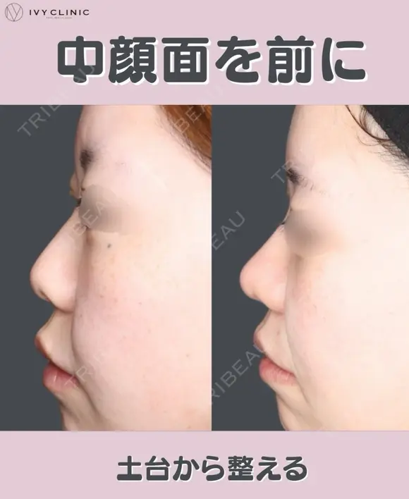 鼻尖形成　軟骨移植 after画像 メイン用