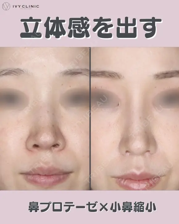 鼻プロテーゼ　小鼻縮小 after画像 メイン用