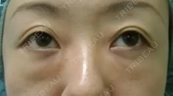 下まぶたの裏側からの脂肪除去(目の下の脂肪除去) | 30代 女性 before画像 メイン用