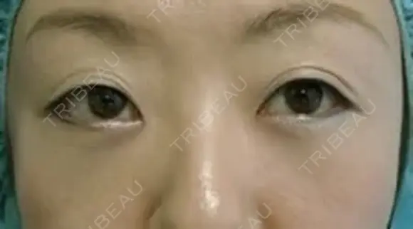 下まぶたの裏側からの脂肪除去(目の下の脂肪除去) | 30代 女性 after画像 メイン用