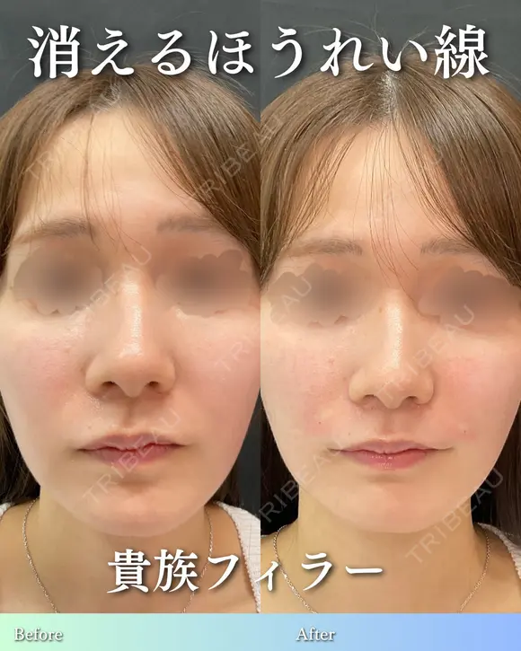 貴族フィラー before画像 メイン用