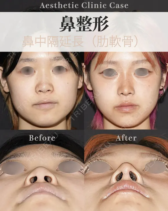 鼻中隔延長(肋軟骨) after画像 メイン用
