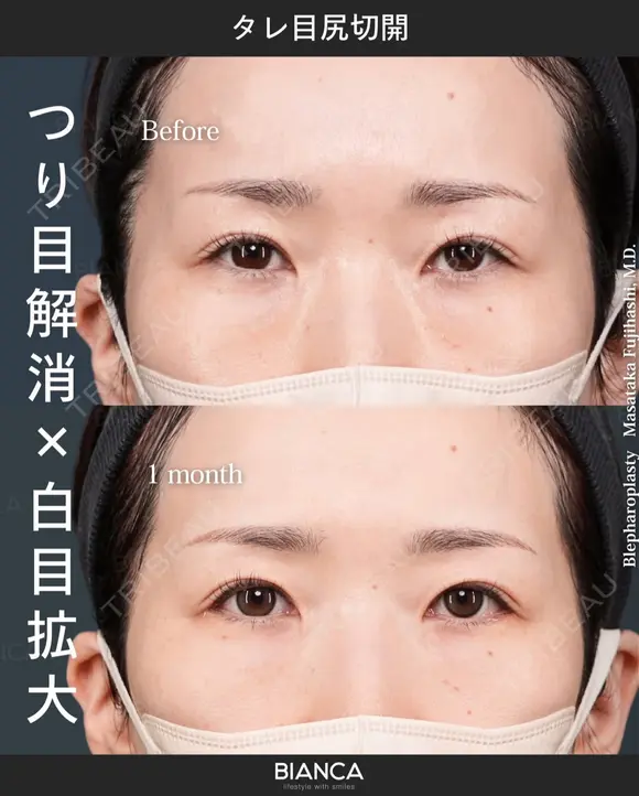 タレ目尻切開 after画像 メイン用