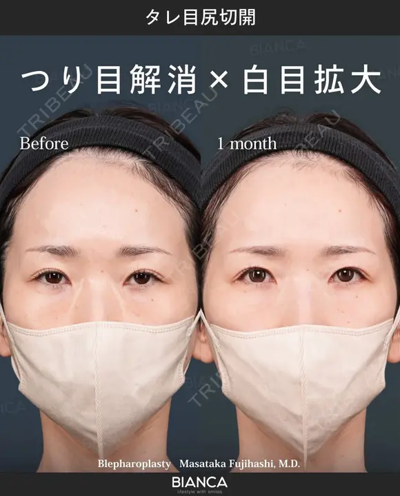 タレ目尻切開 after画像 メイン用